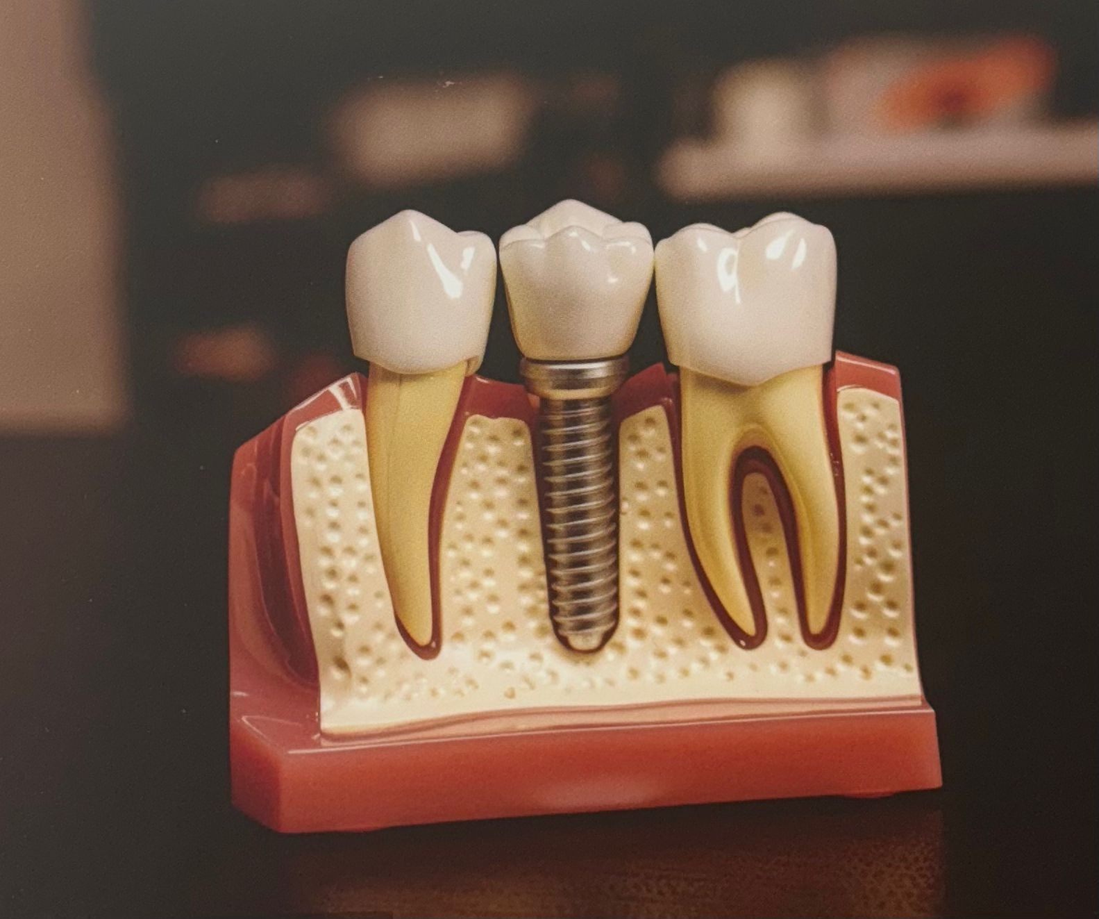 Dental Implants