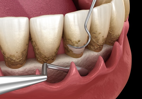 Periodontics